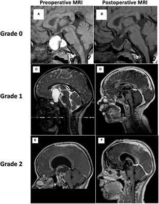 Childhood craniopharyngioma: a retrospective study of children followed in Hôpital Universitaire de Bruxelles